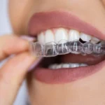 Why Invisalign Milton Keynes Is Transforming the Way People Straighten Their Teeth