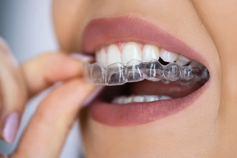 Why Invisalign Milton Keynes Is Transforming the Way People Straighten Their Teeth