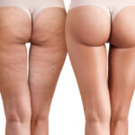 Subcision Cellulite Treatment Explained: Benefits, Procedure and Recovery