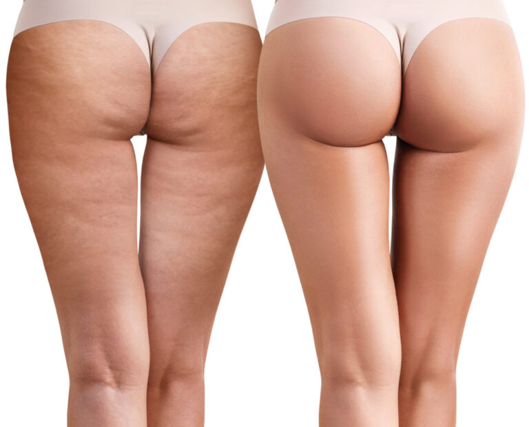 Subcision Cellulite Treatment Explained: Benefits, Procedure and Recovery